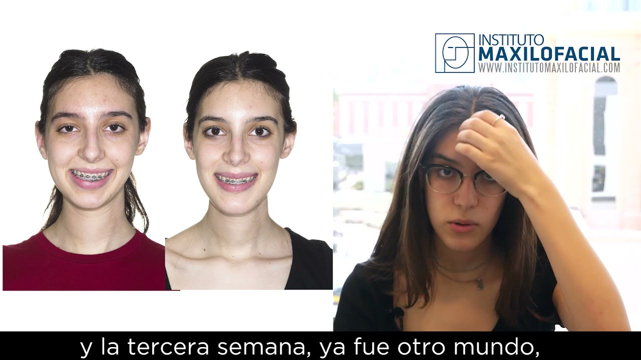 Transforma tu rostro con éxito: Asimetría facial antes y después: los resultados sorprendentes